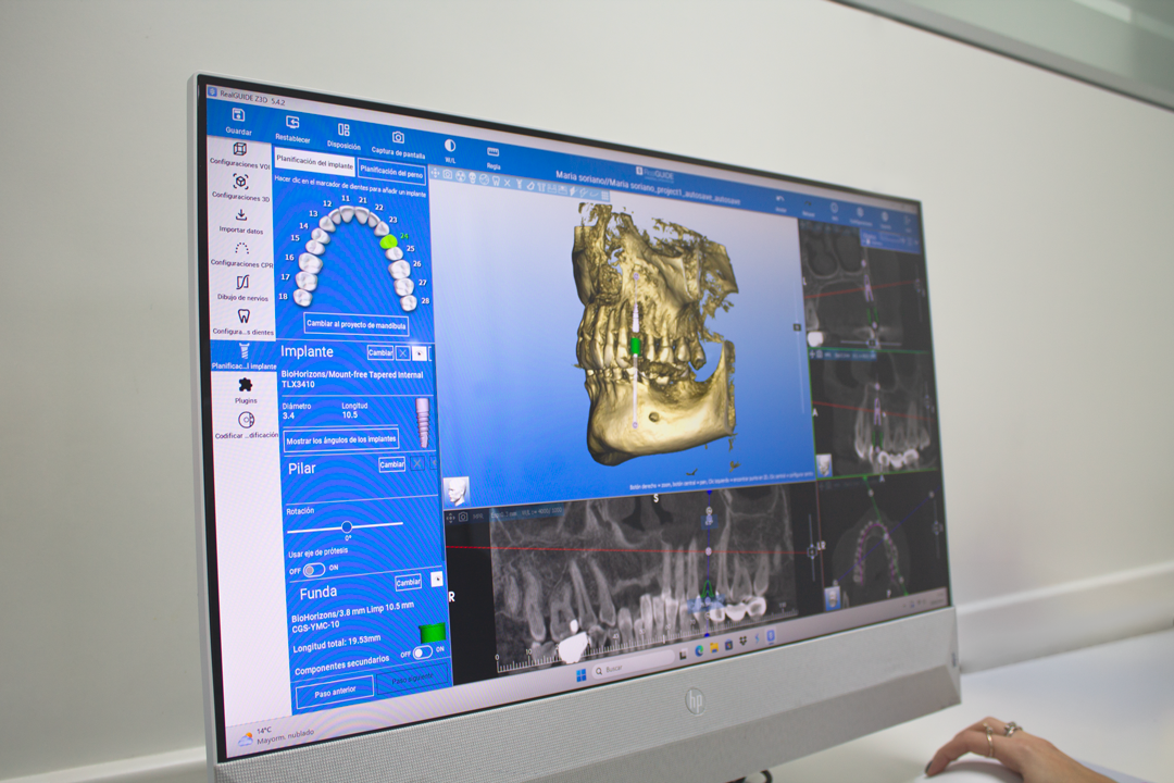 Estudio previo de implantes en Clínica Dental Villalvilla en Xirivella, Valencia