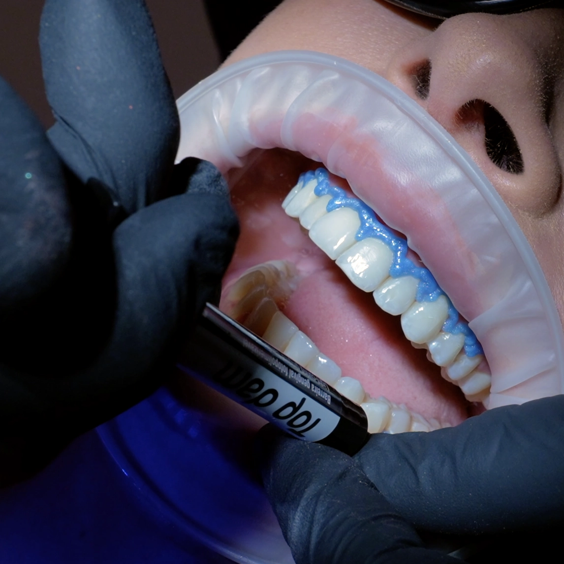 Blanqueamiento dental en Clinica Dental Villalvilla, Xirivella