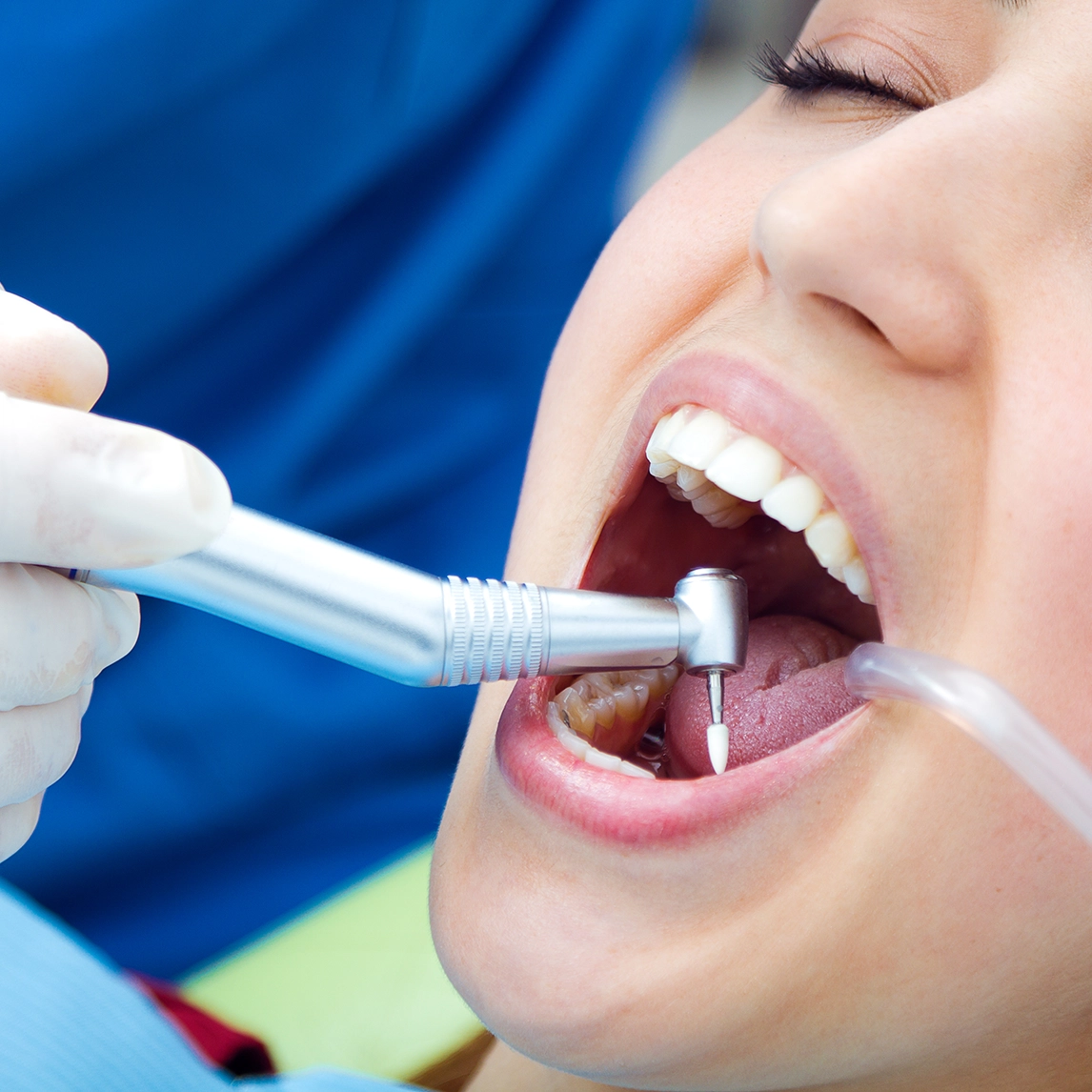 Limpieza dental en Clinica Dental Villalvilla, Xirivella